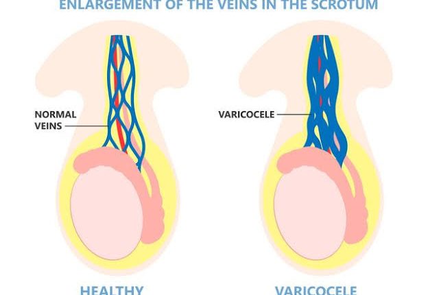 دوالي الخصية